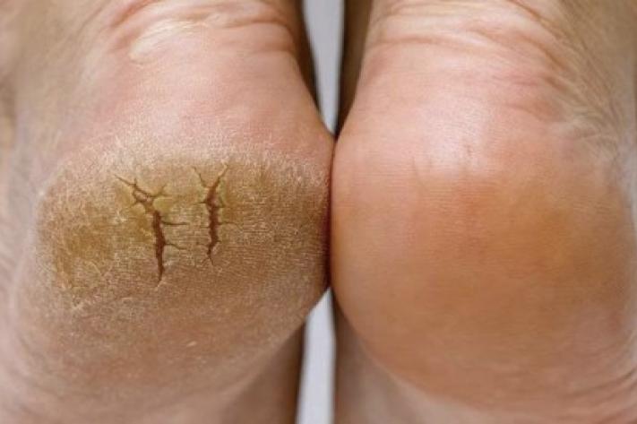 Talons fendilles : causes, prévention et soins au naturel